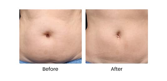 Coolsculpting® by Zeltiq