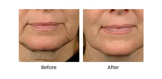 THERMIva® Intimate Rejuvenation