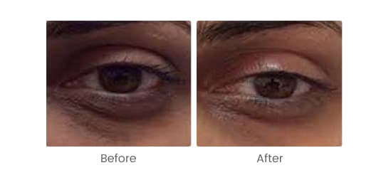 PRP (Platelet Rich Plasma)