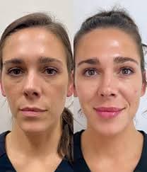Dermal Fillers